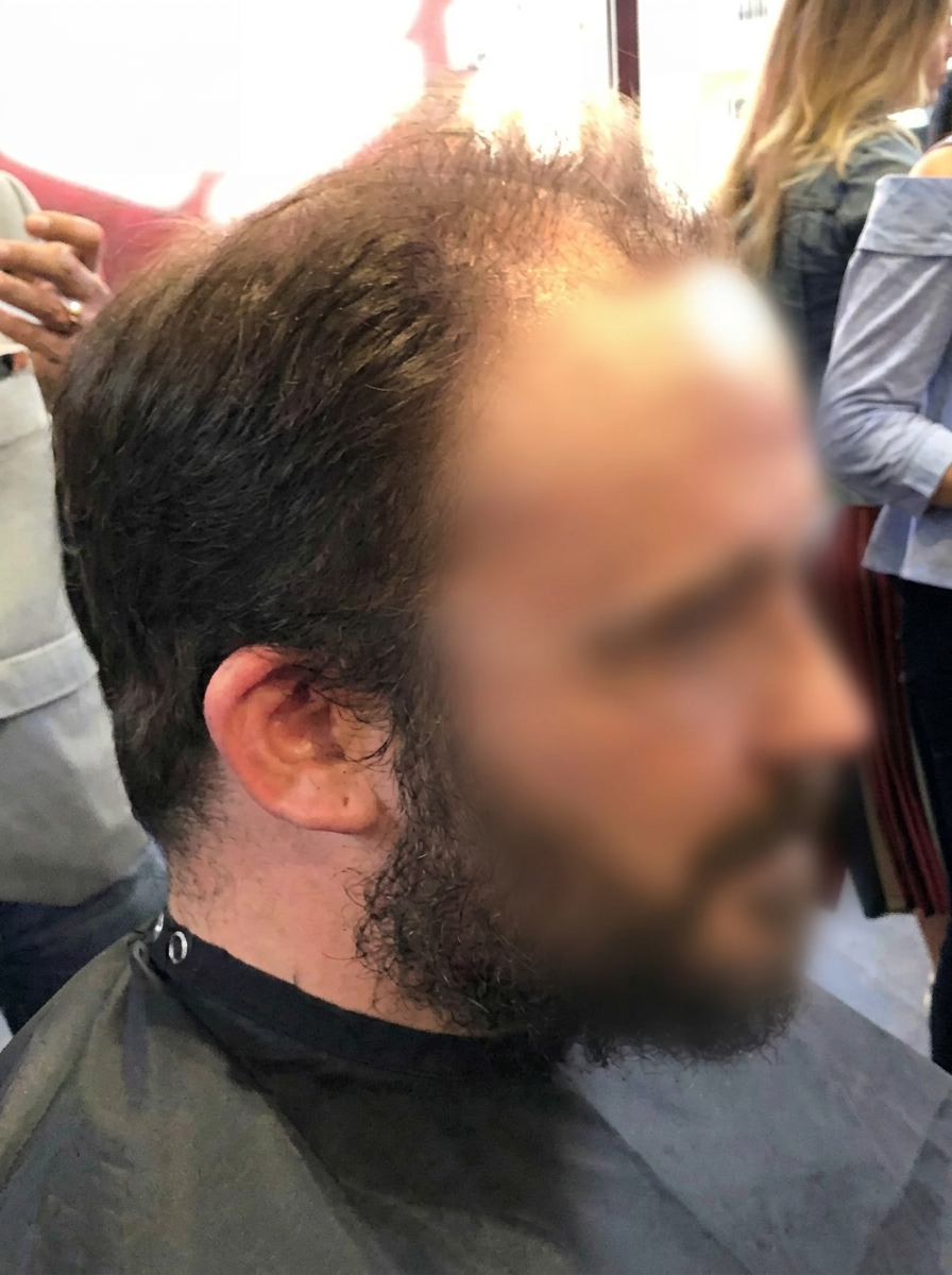 Πριν την αποκατάσταση πυκνότητας